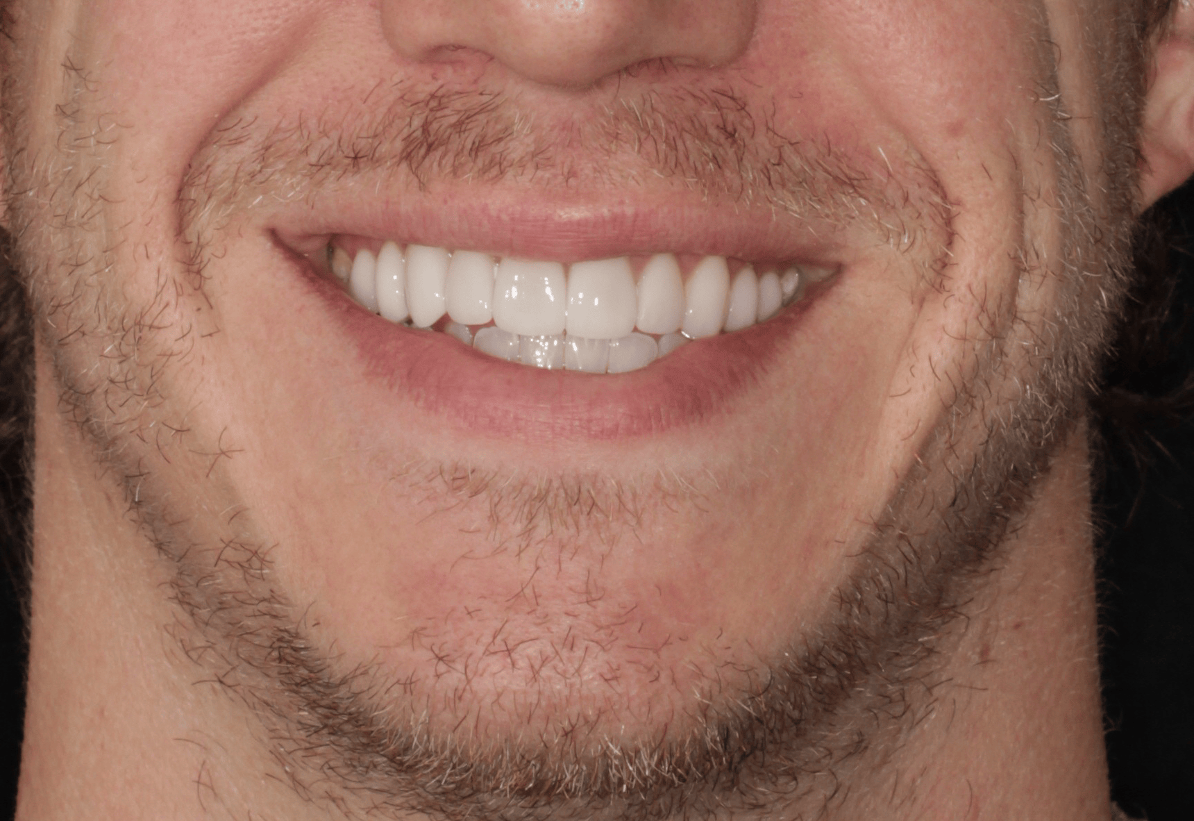 Invisalign After at PCCD