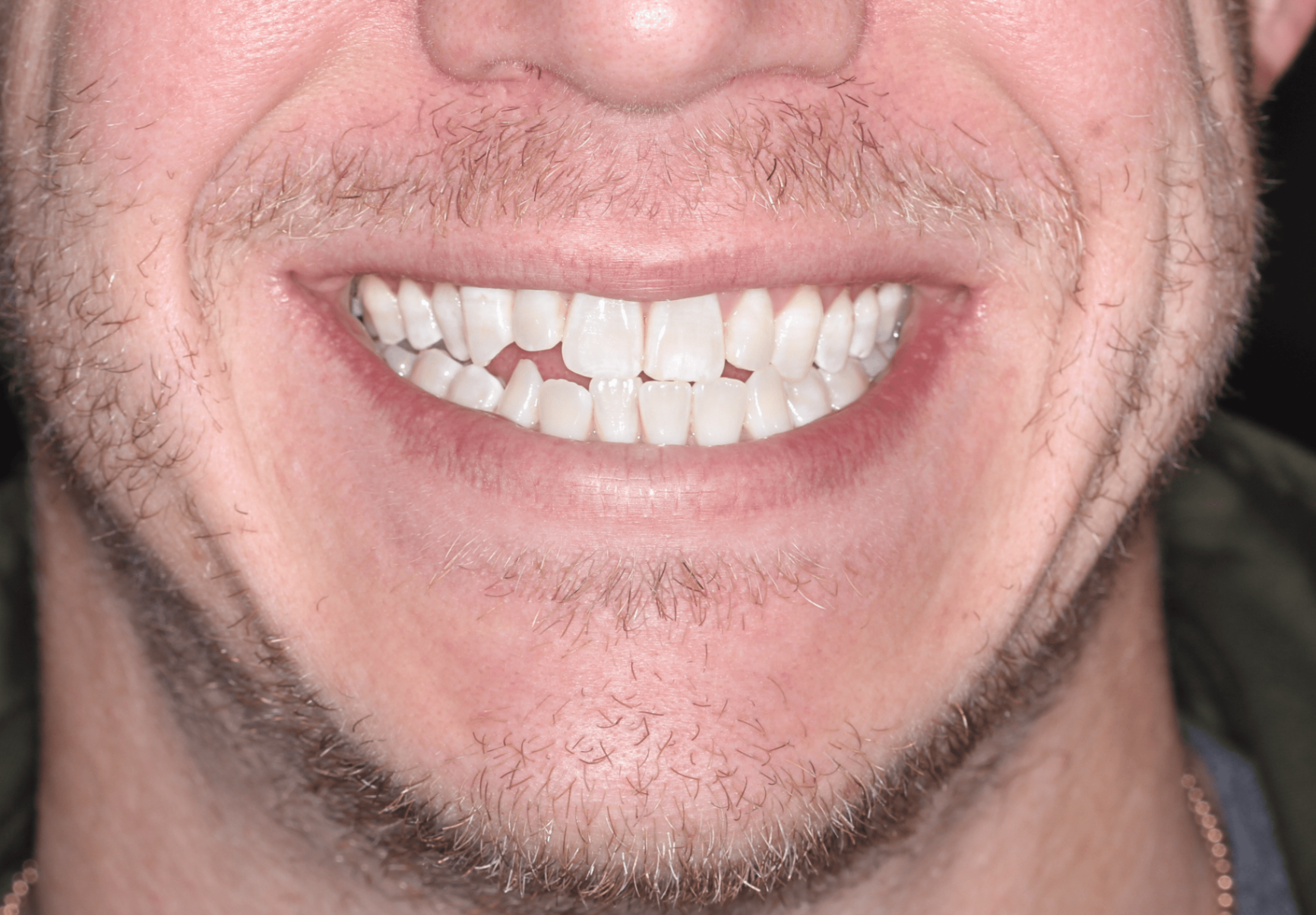Invisalign Before at PCCD