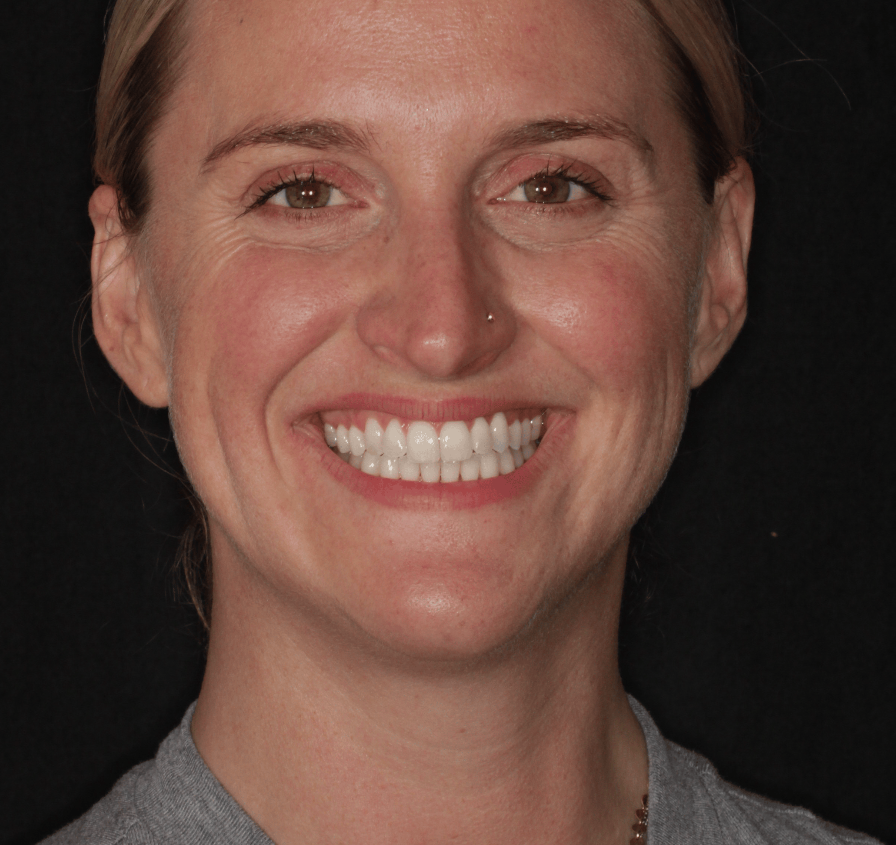 Invisalign After at PCCD