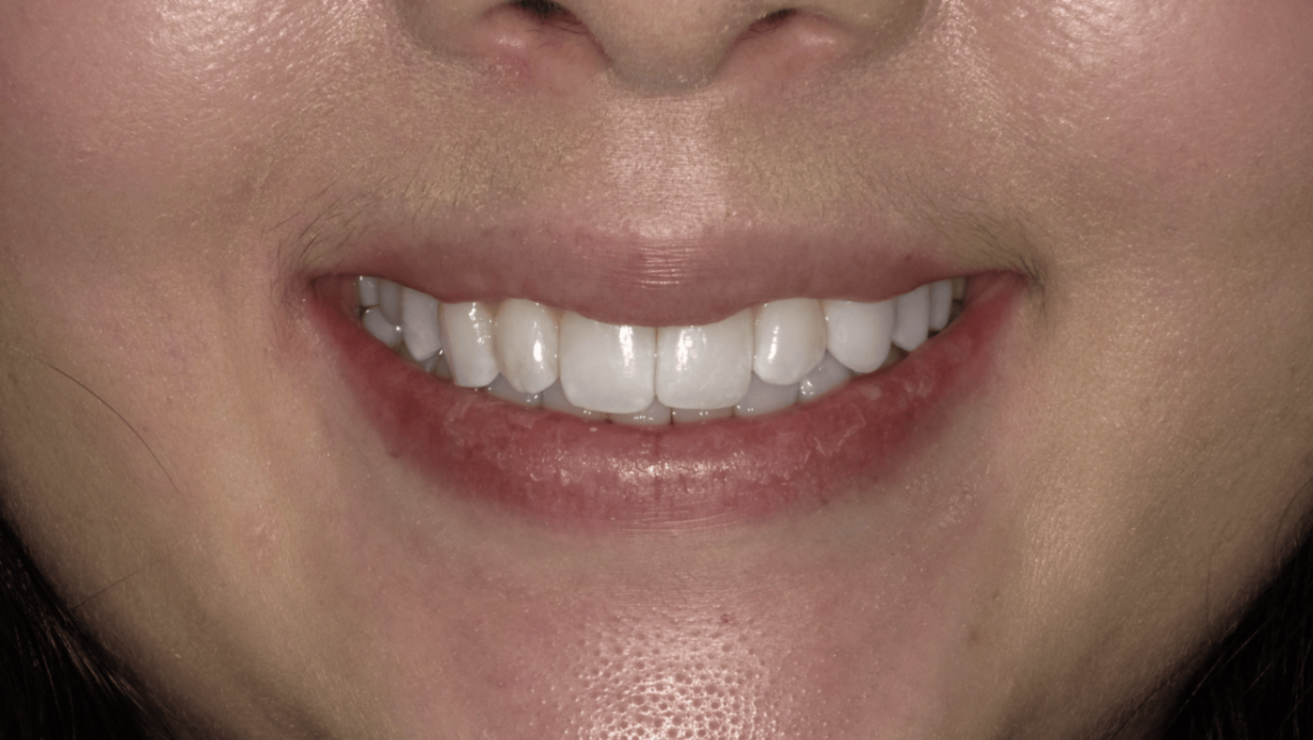 Invisalign After at PCCD