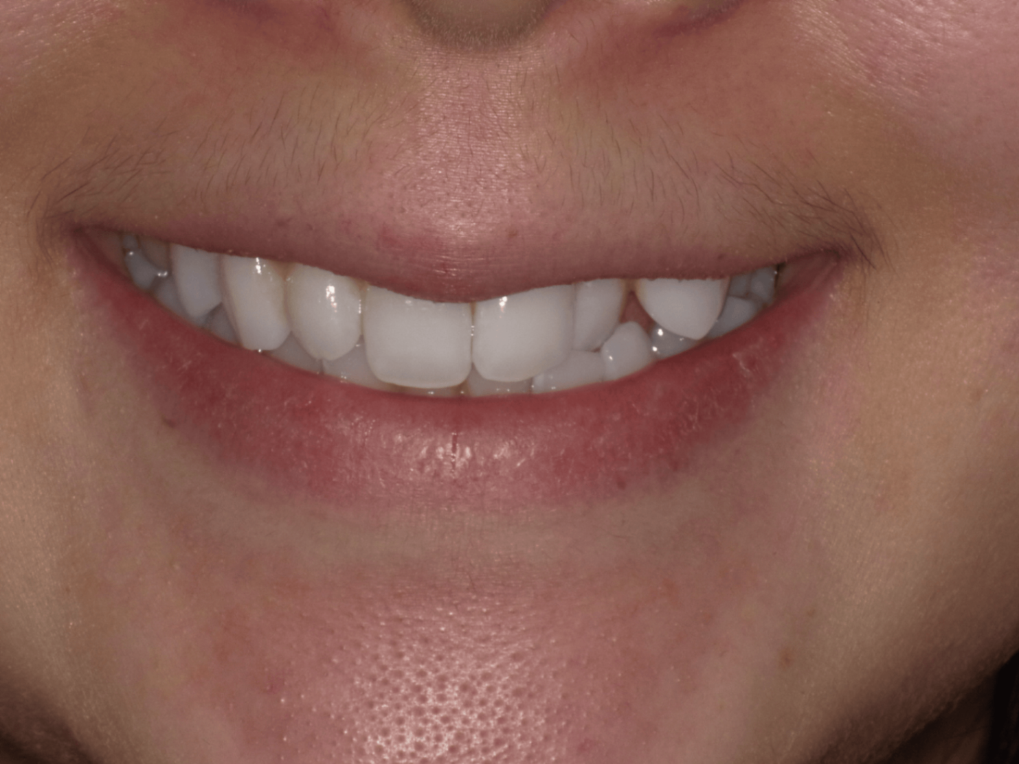 Invisalign Before at PCCD