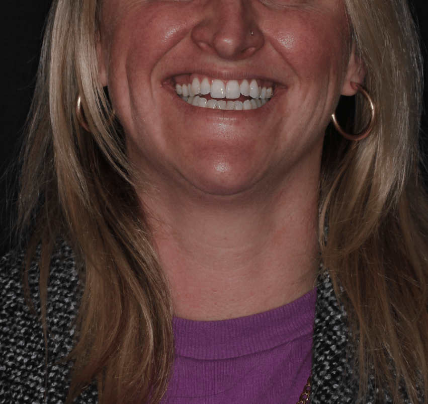 Invisalign Before at PCCD