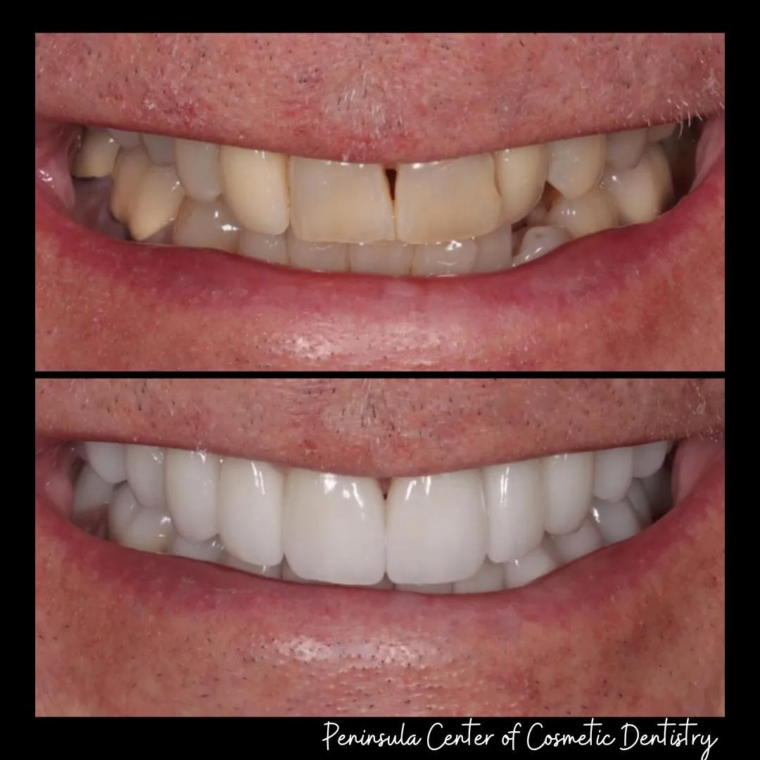 Before and after — Invisalign — Crowding at PCCD