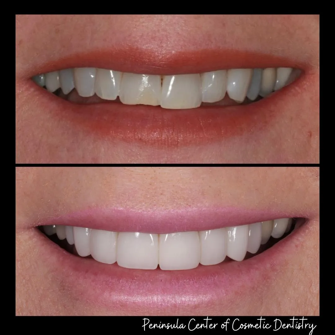 Before and after — Invisalign + Whitening at PCCD