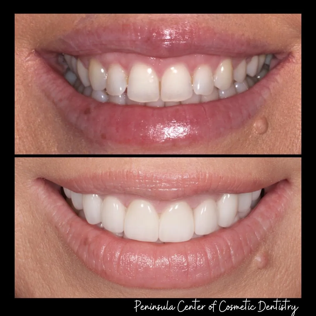 Before and after — Invisalign — Spacing at PCCD