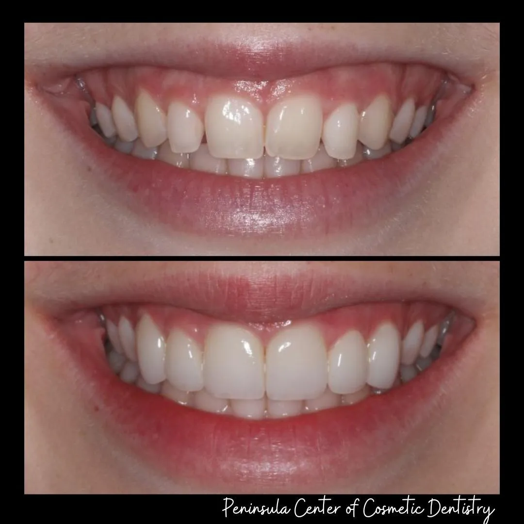 Before and after — Invisalign + Bonding at PCCD