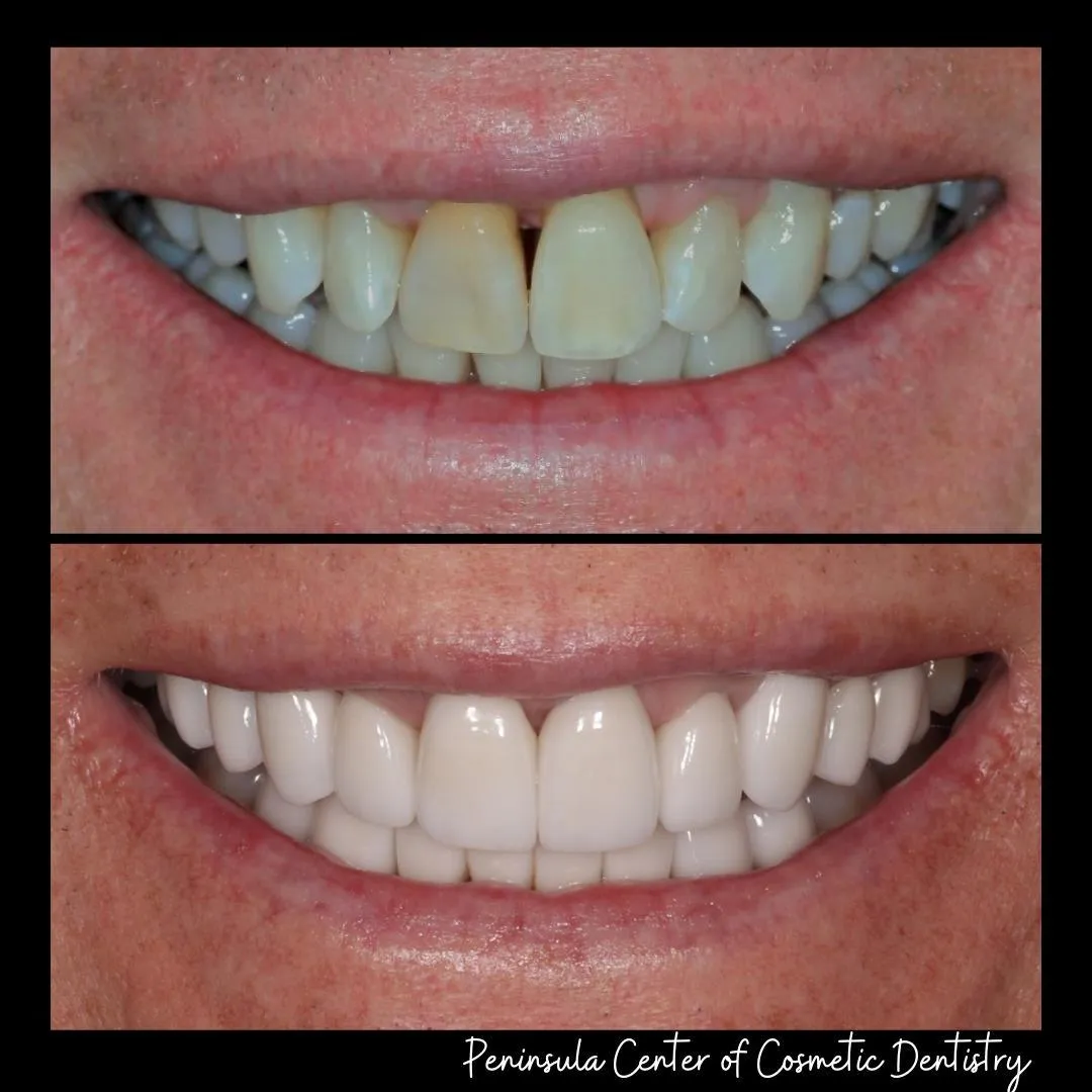 Before and after — Invisalign — Adult Relapse at PCCD
