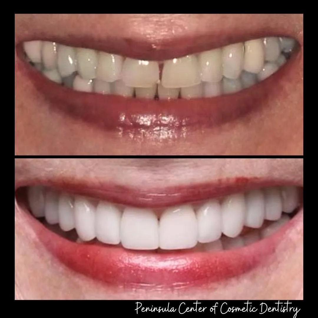 Before and after — Invisalign — Bite Correction at PCCD